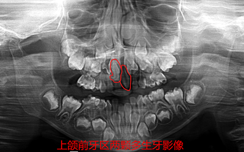 小悅悅口腔全景片_副本.png