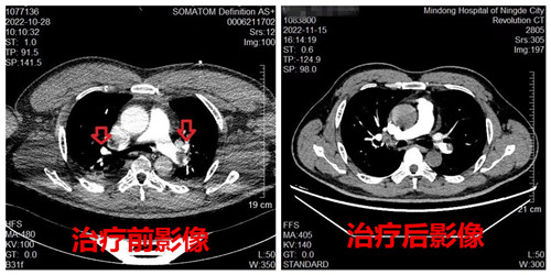 治療前后對(duì)比圖_副本.jpg