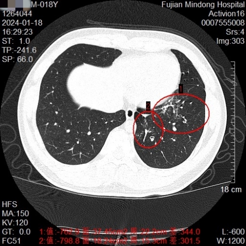 左肺下葉散在炎癥_副本.jpg